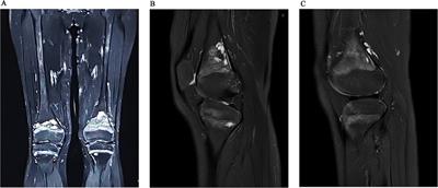 Case Report: Bilateral symmetrical primary kaposiform hemangioendothelioma of the femur